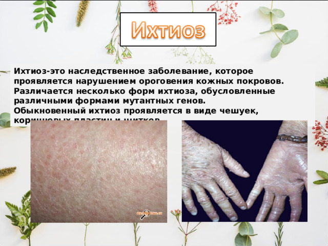 Ихтиоз-это наследственное заболевание, которое проявляется нарушением ороговения кожных покровов. Различается несколько форм ихтиоза, обусловленные различными формами мутантных генов. Обыкновенный ихтиоз проявляется в виде чешуек, коричневых пластин и щитков. 
