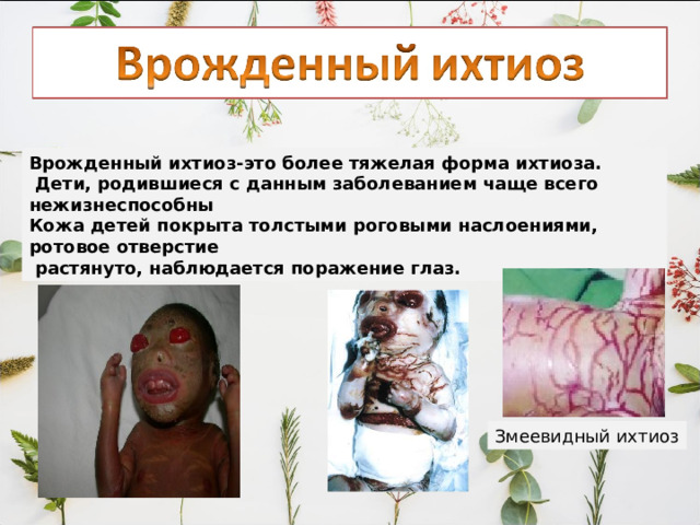 Врожденный ихтиоз-это более тяжелая форма ихтиоза.  Дети, родившиеся с данным заболеванием чаще всего нежизнеспособны Кожа детей покрыта толстыми роговыми наслоениями, ротовое отверстие  растянуто, наблюдается поражение глаз. Змеевидный ихтиоз 