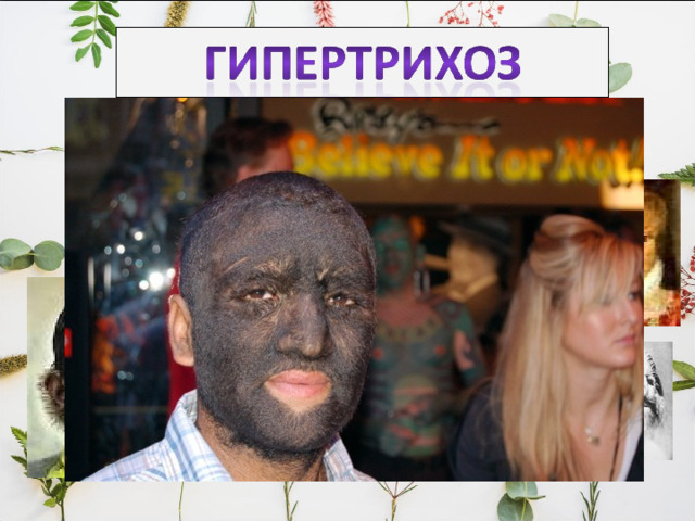 Гипертрихоз-это избыточное оволосение у мужчин. Избыточное оволосение женщин по мужскому типу называется гирсутизм. Причинами гипертрихоза являются: 1.Повышенный уровень половых гормонов 2.Генетические причины 3.Лекарственные причины(избыток кортикостероидов) 4.Идиопатический тип. 