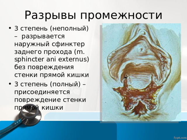 Разрывы промежности 3 степень (неполный) – разрывается наружный сфинктер заднего прохода (m. sphincter ani externus) без повреждения стенки прямой кишки 3 степень (полный) – присоединяется повреждение стенки прямой кишки 