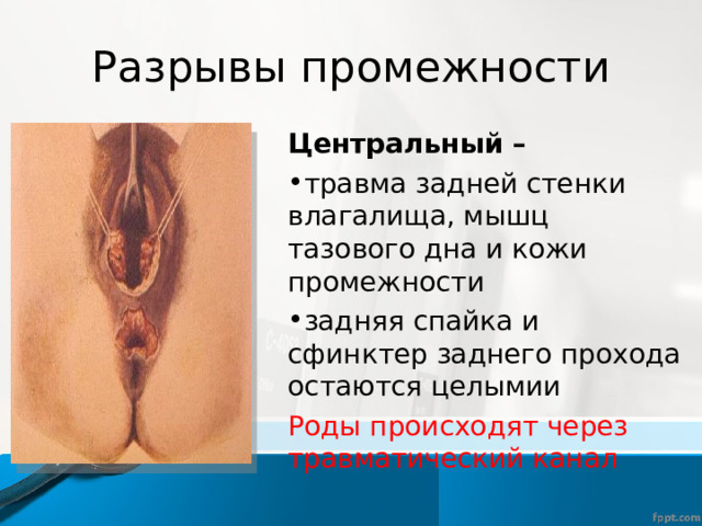 Разрывы промежности Центральный – травма задней стенки влагалища, мышц тазового дна и кожи промежности задняя спайка и сфинктер заднего прохода остаются целымии Роды происходят через травматический канал 