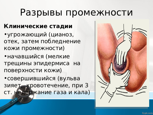 Разрывы промежности Клинические стадии угрожающий (цианоз, отек, затем побледнение кожи промежности) начавшийся (мелкие трещины эпидермиса на поверхности кожи) совершившийся (вульва зияет, кровотечение, при 3 ст. недержание газа и кала) 