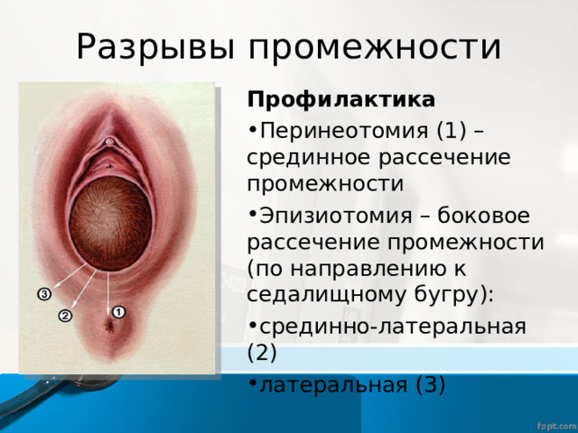 Разрывы промежности Профилактика Перинеотомия (1) – срединное рассечение промежности Эпизиотомия – боковое рассечение промежности (по направлению к седалищному бугру): срединно-латеральная (2) латеральная (3) 