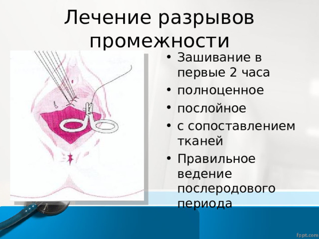 Лечение разрывов промежности Зашивание в первые 2 часа полноценное послойное с сопоставлением тканей Правильное ведение послеродового периода  