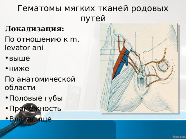 Гематомы мягких тканей родовых путей Локализация: По отношению к m. levator ani выше ниже По анатомической области Половые губы Промежность Влагалище  