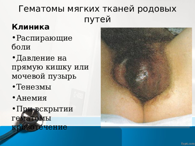 Гематомы мягких тканей родовых путей Клиника Распирающие боли Давление на прямую кишку или мочевой пузырь Тенезмы Анемия При вскрытии гематомы кровотечение 