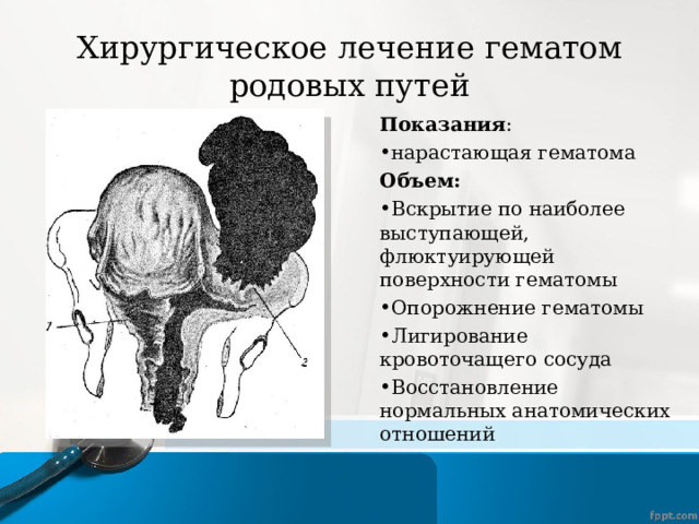 Хирургическое лечение гематом родовых путей Показания : нарастающая гематома Объем: Вскрытие по наиболее выступающей, флюктуирующей поверхности гематомы Опорожнение гематомы Лигирование кровоточащего сосуда Восстановление нормальных анатомических отношений 