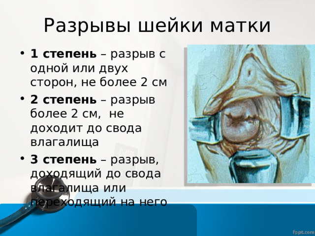 Разрывы шейки матки 1 степень – разрыв с одной или двух сторон, не более 2 см 2 степень – разрыв более 2 см, не доходит до свода влагалища 3 степень – разрыв, доходящий до свода влагалища или переходящий на него 