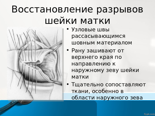 Восстановление разрывов шейки матки Узловые швы рассасывающимся шовным материалом Рану зашивают от верхнего края по направлению к наружному зеву шейки матки Тщательно сопоставляют ткани, особенно в области наружного зева 