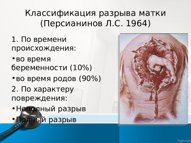 Классификация разрыва матки (Персианинов Л.С. 1964) 1. По времени происхождения: во время беременности (10%) во время родов (90%) 2. По характеру повреждения: Неполный разрыв Полный разрыв  