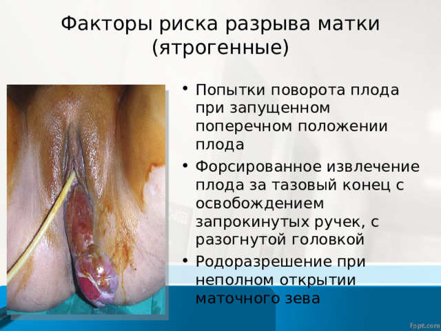 Факторы риска разрыва матки (ятрогенные) Попытки поворота плода при запущенном поперечном положении плода Форсированное извлечение плода за тазовый конец с освобождением запрокинутых ручек, с разогнутой головкой Родоразрешение при неполном открытии маточного зева 