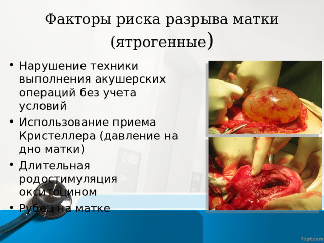 Факторы риска разрыва матки (ятрогенные ) Нарушение техники выполнения акушерских операций без учета условий Использование приема Кристеллера (давление на дно матки) Длительная родостимуляция окситоцином Рубец на матке 