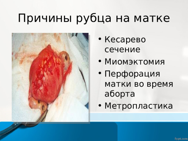 Причины рубца на матке Кесарево сечение Миомэктомия Перфорация матки во время аборта Метропластика  