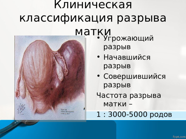 Клиническая классификация разрыва матки Угрожающий разрыв Начавшийся разрыв Совершившийся разрыв Частота разрыва матки – 1 : 3000-5000 родов 
