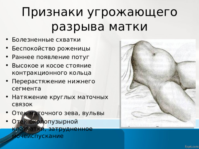 Признаки угрожающего разрыва матки Болезненные схватки Беспокойство роженицы Раннее появление потуг Высокое и косое стояние контракционного кольца Перерастяжение нижнего сегмента Натяжение круглых маточных связок Отек маточного зева, вульвы Отек околопузырной клетчатки, затрудненное мочеиспускание  