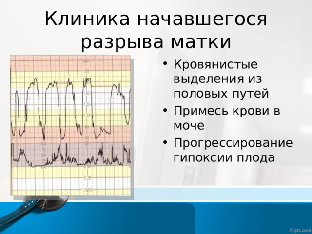 Клиника начавшегося разрыва матки Кровянистые выделения из половых путей Примесь крови в моче Прогрессирование гипоксии плода  