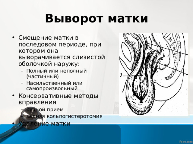 Выворот матки Смещение матки в последовом периоде, при котором она выворачивается слизистой оболочкой наружу: Полный или неполный (частичный) Насильственный или самопроизвольный Полный или неполный (частичный) Насильственный или самопроизвольный Консервативные методы вправления ручной прием задняя кольпогистеротомия ручной прием задняя кольпогистеротомия Удаление матки 