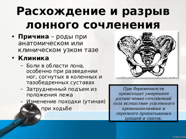 Расхождение и разрыв лонного сочленения Причина – роды при анатомическом или клиническом узком тазе Клиника Боли в области лона, особенно при разведении ног, согнутых в коленных и тазобедренных суставах Затрудненный подъем из положения лежа Изменение походки (утиная) Боль при ходьбе Боли в области лона, особенно при разведении ног, согнутых в коленных и тазобедренных суставах Затрудненный подъем из положения лежа Изменение походки (утиная) Боль при ходьбе При беременности происходит умеренное размягчение сочленений таза вследствие усиленного кровенаполнения и серозного пропитывания хрящей и связок. 