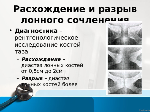 Расхождение и разрыв лонного сочленения Диагностика – рентгенологическое исследование костей таза Расхождение – диастаз лонных костей от 0,5см до 2см Разрыв – диастаз лонных костей более 2см. Расхождение – диастаз лонных костей от 0,5см до 2см Разрыв – диастаз лонных костей более 2см. 