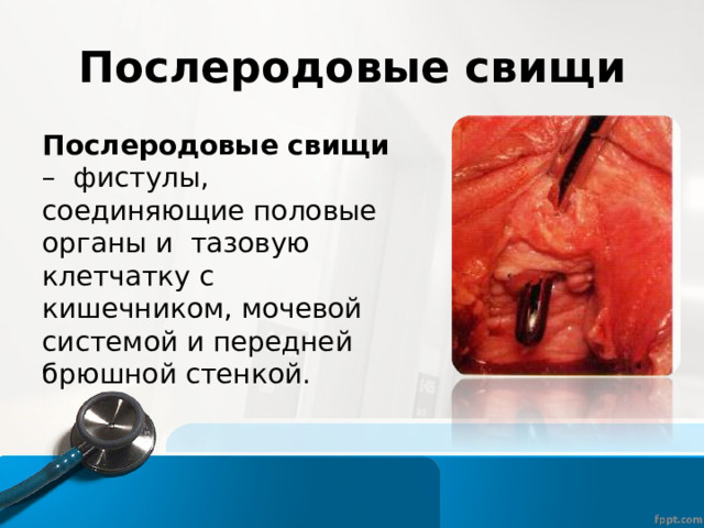 Послеродовые свищи Послеродовые свищи – фистулы, соединяющие половые органы и тазовую клетчатку с кишечником, мочевой системой и передней брюшной стенкой. 