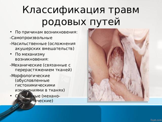 Классификация травм родовых путей По причинам возникновения: -Самопроизвольные -Насильственные (осложнения акушерских вмешательств) По механизму возникновения: -Механические (связанные с перерастяжением тканей) -Морфологические (обусловленные гистохимическими изменениями в тканях) Смешанные (механо-гистопатические) 