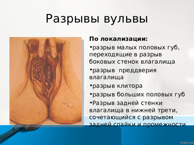 Разрывы вульвы По локализации: разрыв малых половых губ, переходящие в разрыв боковых стенок влагалища разрыв преддверия влагалища разрыв клитора разрыв больших половых губ Разрыв задней стенки влагалища в нижней трети, сочетающийся с разрывом задней спайки и промежности 