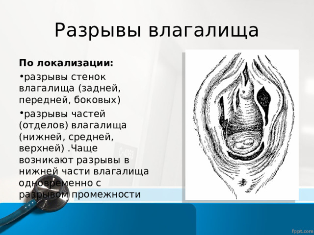 Разрывы влагалища По локализации: разрывы стенок влагалища (задней, передней, боковых) разрывы частей (отделов) влагалища (нижней, средней, верхней) .Чаще возникают разрывы в нижней части влагалища одновременно с разрывом промежности 