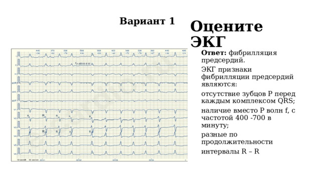 Вариант 1 Оцените ЭКГ Ответ: фибрилляция предсердий. ЭКГ признаки фибрилляции предсердий являются: отсутствие зубцов P перед каждым комплексом QRS; наличие вместо Р волн f, с частотой 400 -700 в минуту; разные по продолжительности интервалы R – R  