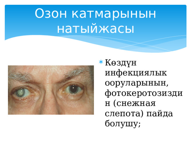 Озон катмарынын натыйжасы Көздүн инфекциялык ооруларынын, фотокеротозиздин (снежная слепота) пайда болушу;   