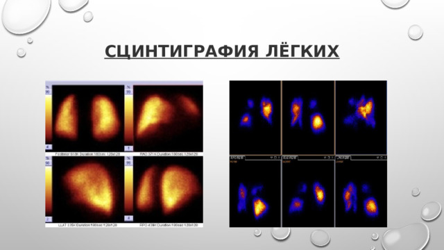Сцинтиграфия лёгких 