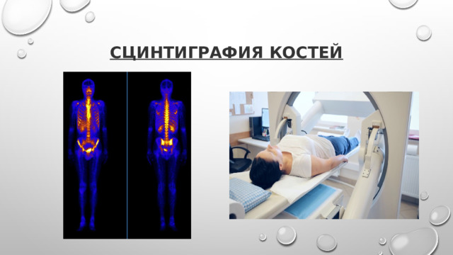Сцинтиграфия костей 