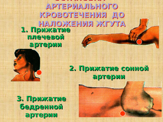 ОСТАНОВКА АРТЕРИАЛЬНОГО КРОВОТЕЧЕНИЯ ДО НАЛОЖЕНИЯ ЖГУТА 1. Прижатие плечевой артерии 2. Прижатие сонной артерии 3. Прижатие бедренной артерии 