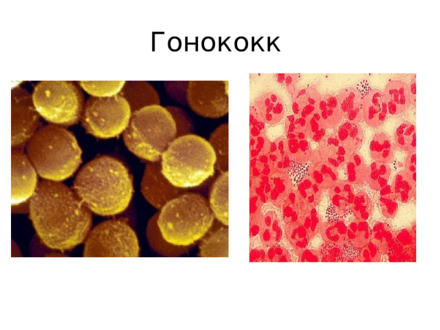 Гонококк 