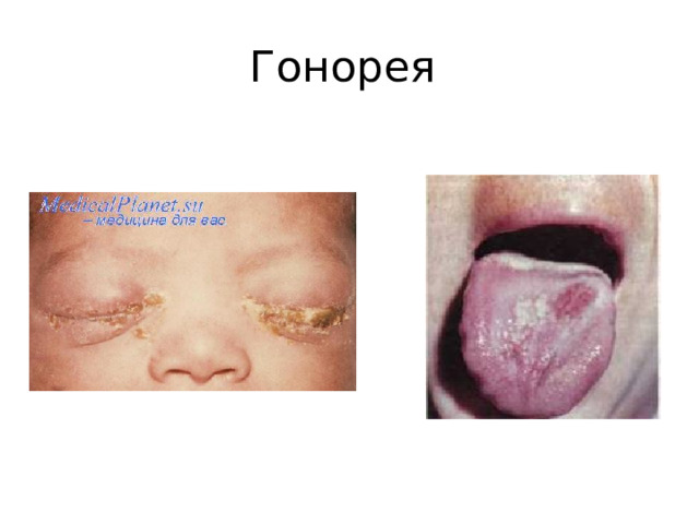 Гонорея 