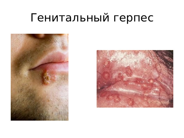Генитальный герпес 