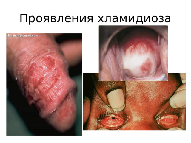 Проявления хламидиоза 