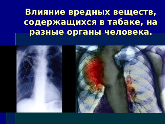 Влияние вредных веществ, содержащихся в табаке, на разные органы человека. 