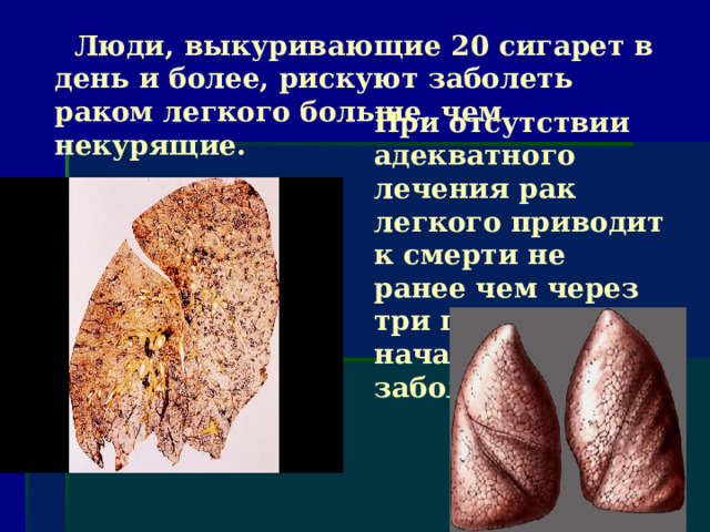  Люди, выкуривающие 20 сигарет в день и более, рискуют заболеть раком легкого больше, чем некурящие. При отсутствии адекватного лечения рак легкого приводит к смерти не ранее чем через три года от начала заболевания. 