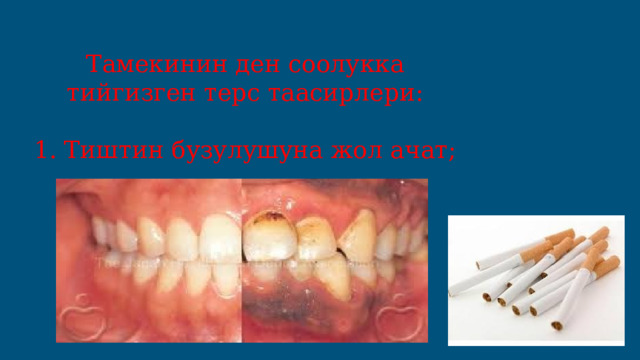 Тамекинин ден соолукка тийгизген терс таасирлери: 1. Тиштин бузулушуна жол ачат; 