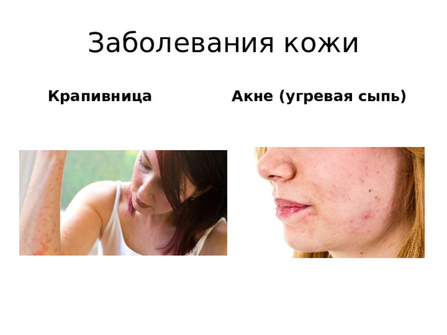 Заболевания кожи  Крапивница Акне (угревая сыпь) 