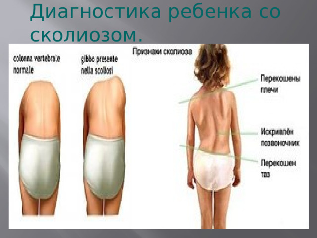 Диагностика ребенка со сколиозом. 