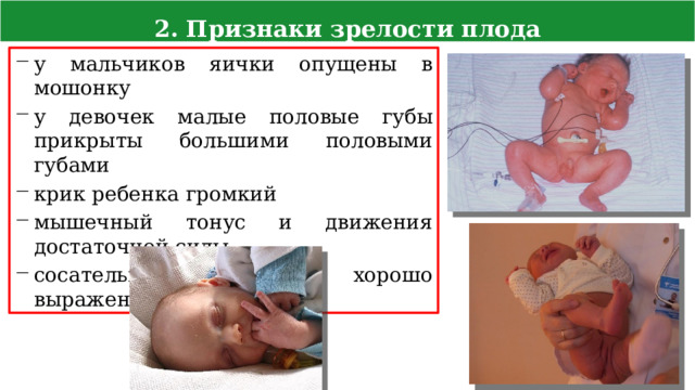 2. Признаки зрелости плода у мальчиков яички опущены в мошонку у девочек малые половые губы прикрыты большими половыми губами крик ребенка громкий мышечный тонус и движения достаточной силы сосательный рефлекс хорошо выражен 