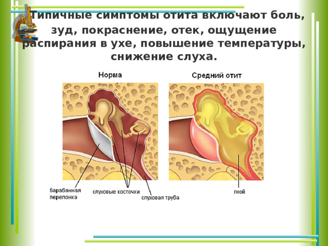   Типичные симптомы отита включают боль, зуд, покраснение, отек, ощущение распирания в ухе, повышение температуры, снижение слуха. 