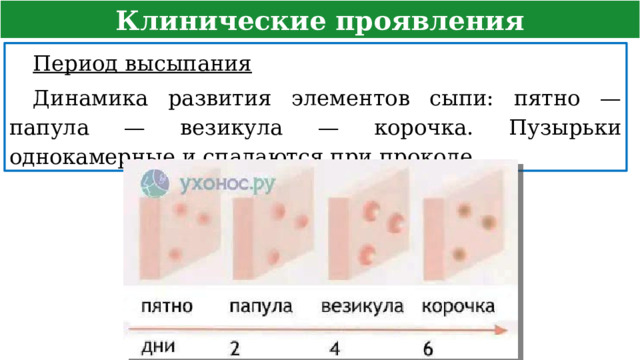 Клинические проявления Период высыпания  Динамика развития элементов сыпи: пятно — папула — везикула — корочка. Пузырьки однокамерные и спадаются при проколе.  