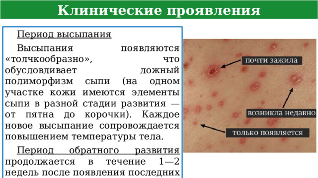 Клинические проявления Период высыпания  Высыпания появляются «толчкообразно», что обусловливает ложный полиморфизм сыпи (на одном участке кожи имеются элементы сыпи в разной стадии развития — от пятна до корочки). Каждое новое высыпание сопровождается повышением температуры тела. Период обратного развития продолжается в течение 1—2 недель после появления последних элементов сыпи  