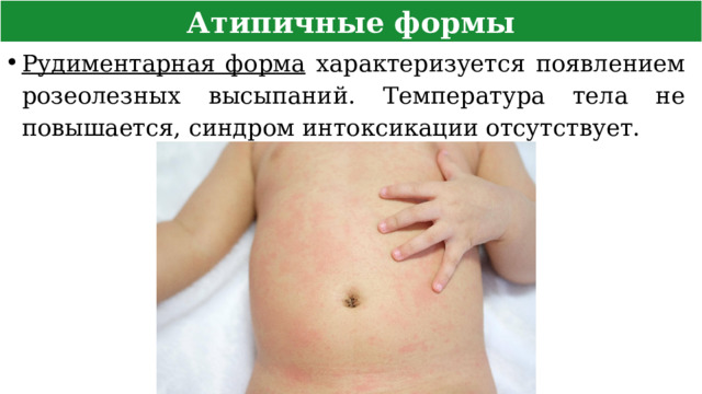 Атипичные формы Рудиментарная форма характеризуется появлением розеолезных высыпаний. Температура тела не повышается, синдром интоксикации отсутствует.  