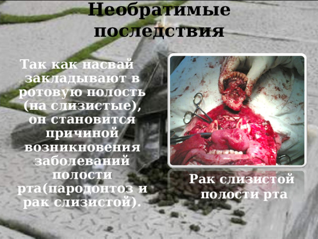 Необратимые последствия   Так как насвай закладывают в ротовую полость (на слизистые), он становится причиной возникновения заболеваний полости рта(пародонтоз и рак слизистой).  Рак слизистой полости рта 