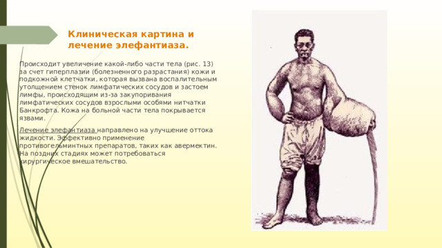 Клиническая картина и лечение элефантиаза. Происходит увеличение какой-либо части тела (рис. 13) за счет гиперплазии (болезненного разрастания) кожи и подкожной клетчатки, которая вызвана воспалительным утолщением стенок лимфатических сосудов и застоем лимфы, происходящим из-за закупоривания лимфатических сосудов взрослыми особями нитчатки Банкрофта. Кожа на больной части тела покрывается язвами. Лечение элефантиаза направлено на улучшение оттока жидкости. Эффективно применение противогельминтных препаратов, таких как авермектин. На поздних стадиях может потребоваться хирургическое вмешательство. 