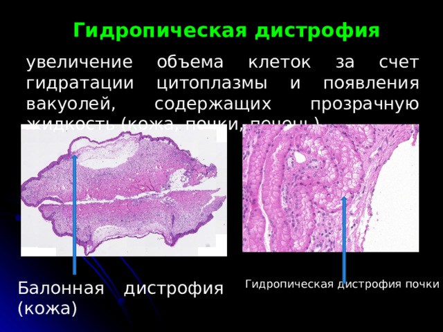  Гидропическая дистрофия   увеличение объема клеток за счет гидратации цитоплазмы и появления вакуолей, содержащих прозрачную жидкость (кожа, почки, печень). Балонная дистрофия (кожа) Гидропическая дистрофия почки 