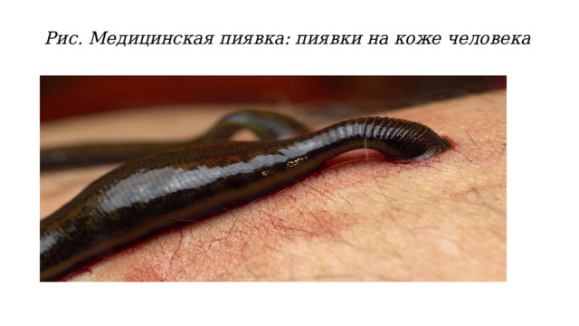 Рис. Медицинская пиявка: пиявки на коже человека   
